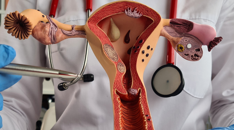 alimentos-com-carga-glicemica-alta-podem-aumentar-risco-de-cancro-do-endometrio