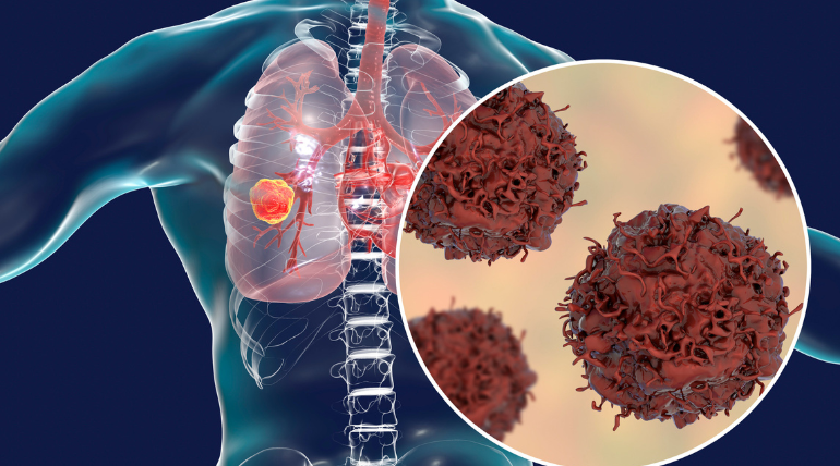 deficiencia-de-vitamina-d-podera-aumentar-o-risco-de-cancro-do-pulmao-em-fumadores