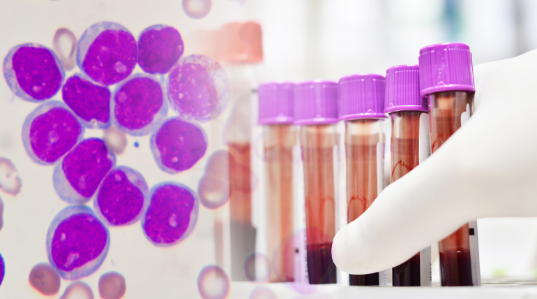 leucemia-de-tipo-muito-agressivo-pode-ser-provocada-por-inflamacao-cronica